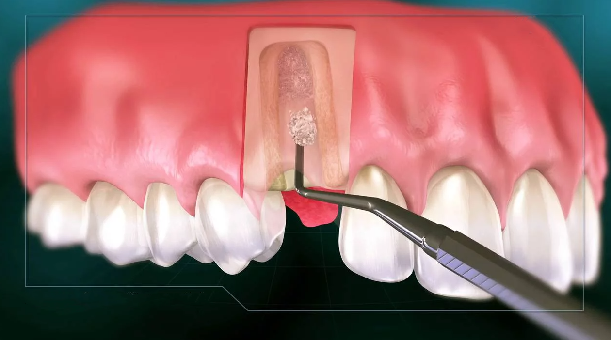 پیوند استخوان برای کاشت ایمپلنت های دندانی