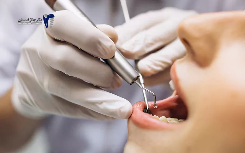 از بین عفونت دندان یا درمان ریشه دندان