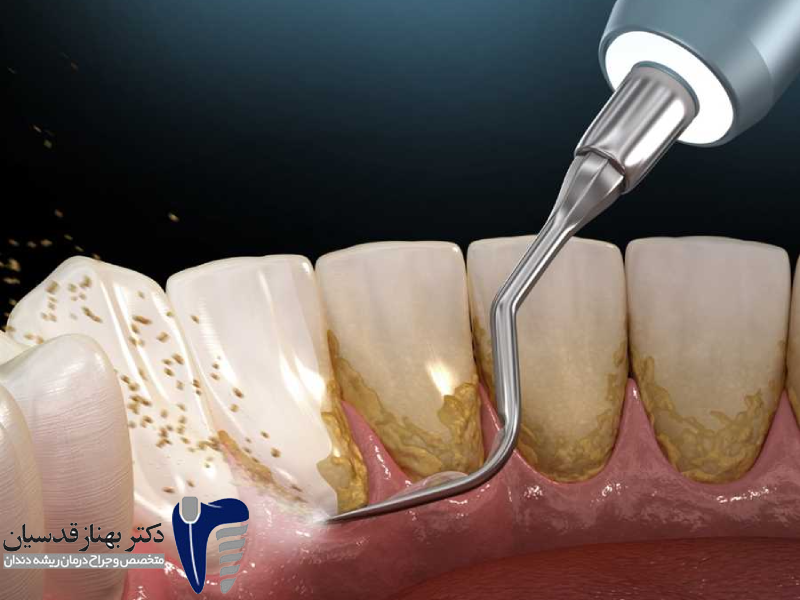 روش های جرمگیری دندان لمینیت شده