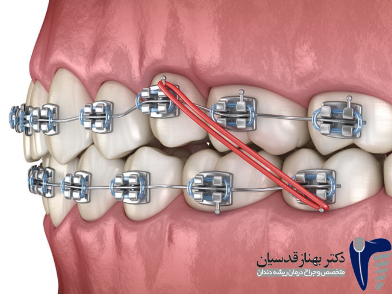 ارتودنسی، درمان مشکلات فکی