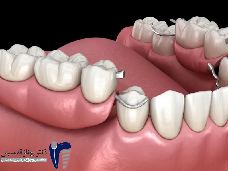 فلیپر دندان: راهکاری موقت و مقرون به صرفه برای جایگزینی دندان از دست رفته